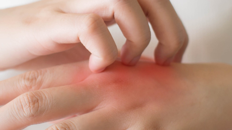 Woman scratching dermatitis on hand