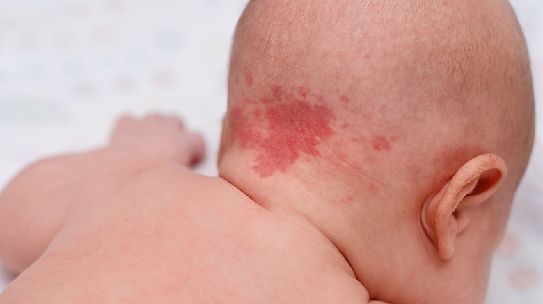 Strawberry hemangioma on baby's head