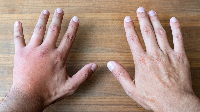 2 hands placed on a desk, one hand is swollen