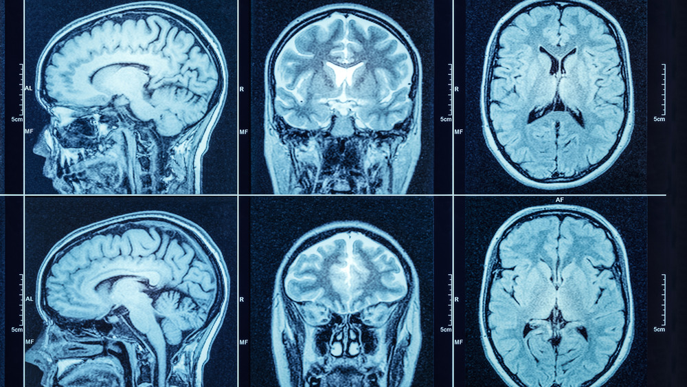 Images of a person's head from a CT scan