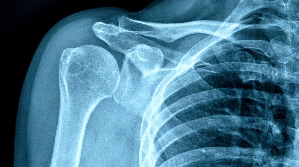 X-ray of a human shoulder