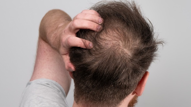 male pattern baldness 