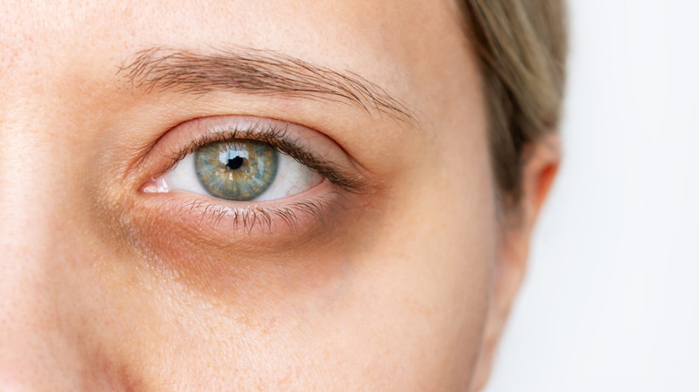 Dark circles under eyes
