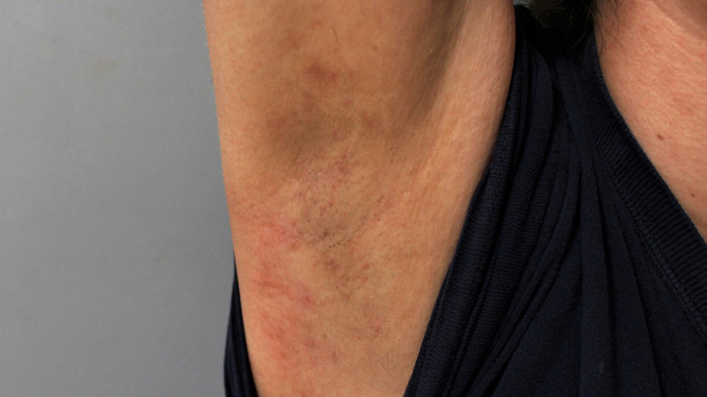 Armpit irritated from shaving 