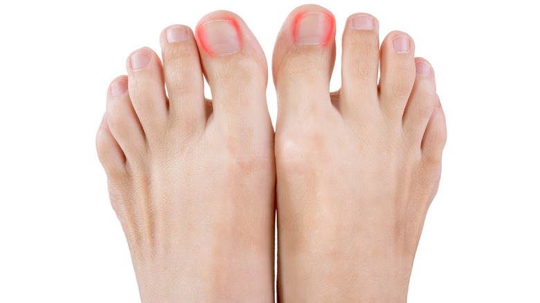 Ingrown toenails on woman's foot