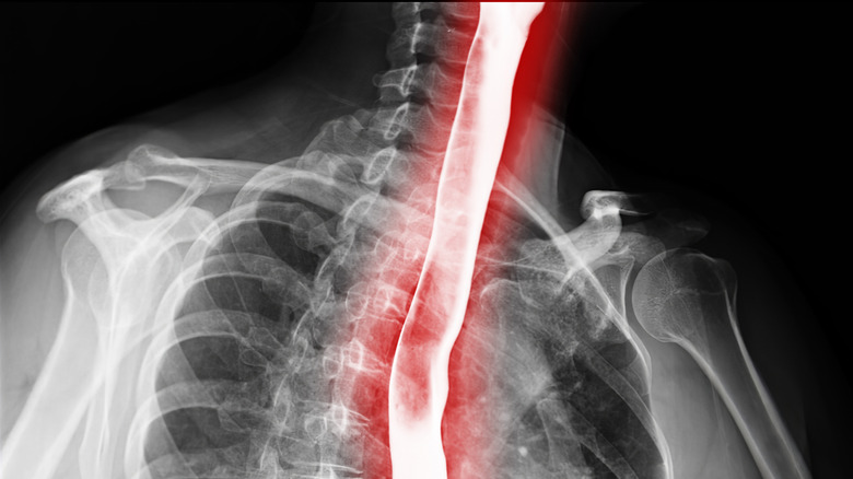 X-ray picture of esophagus