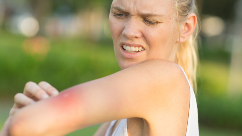 A woman looks at a bee sting on her arm.