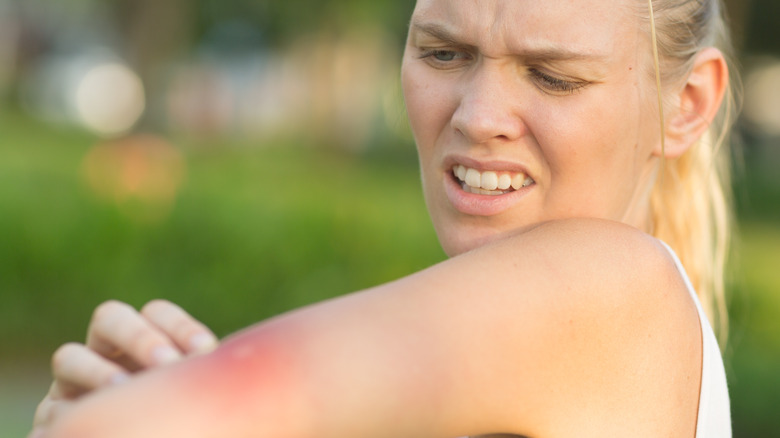 Woman with insect sting on arm