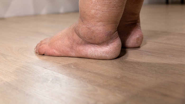 feet and swollen legs