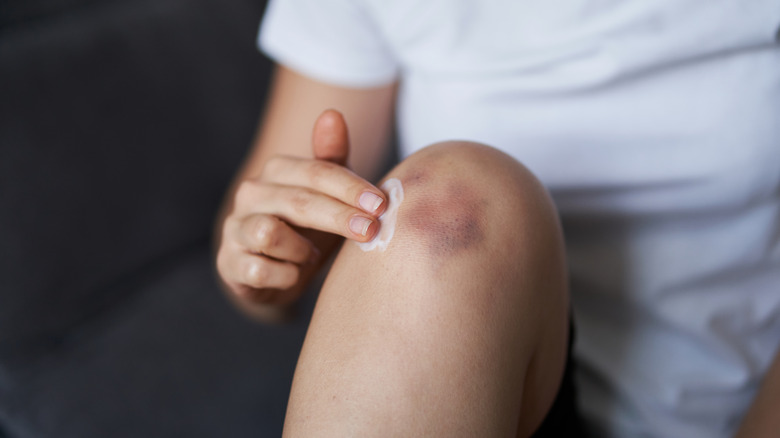 Close up of a person rubbing cream on bruised knee