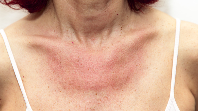 Sun rash on woman's chest