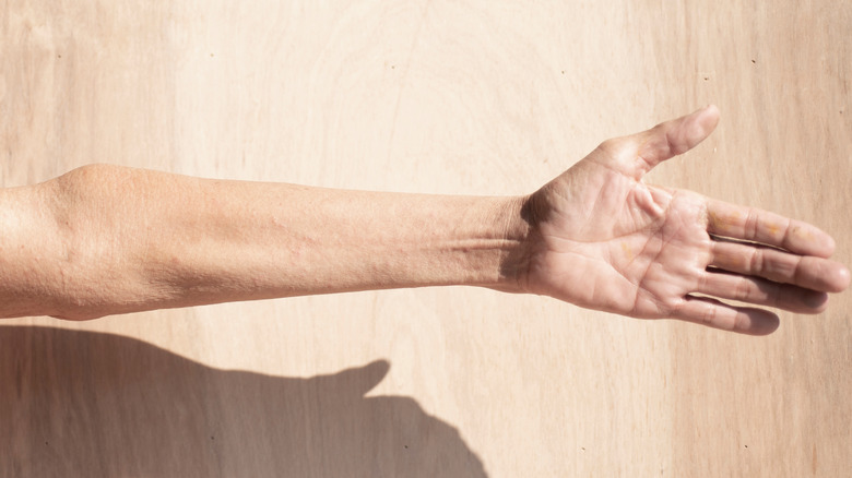 man's arm with muscular atrophy