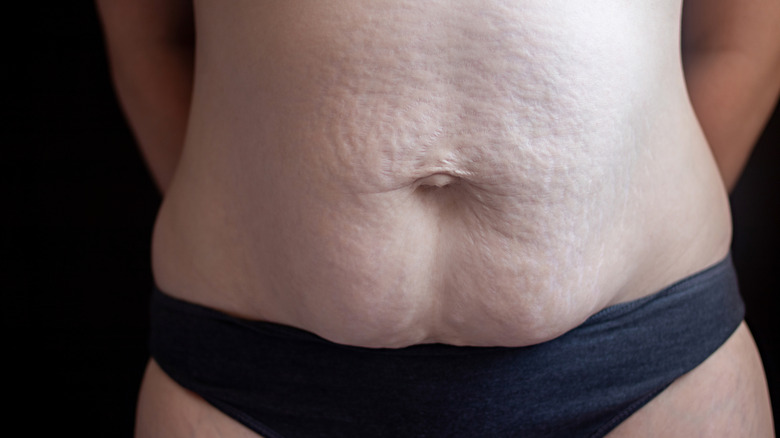 What is Diastasis Recti?