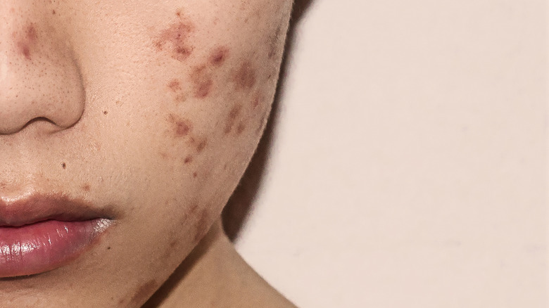 close up of a young male's cheek acne 