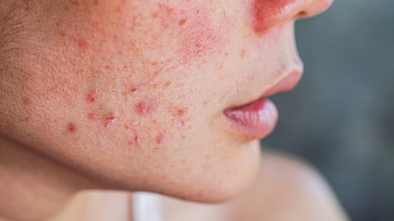 Close up of acne on a person's chin