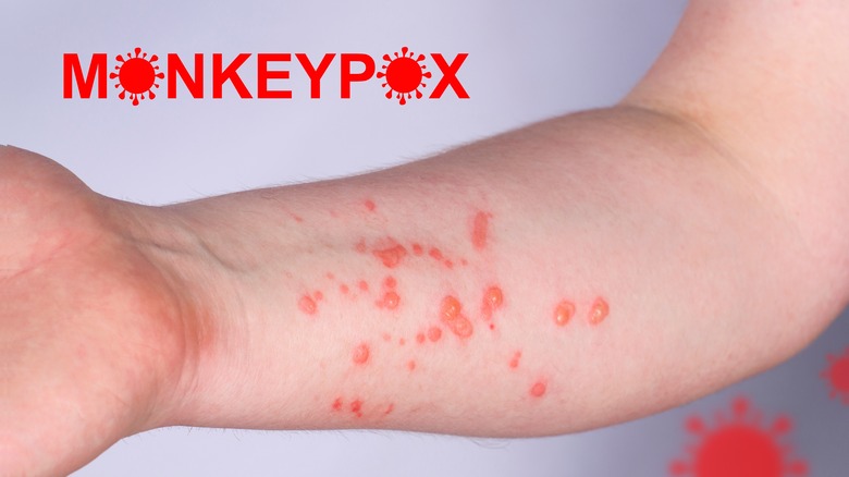 arm with monkeypox
