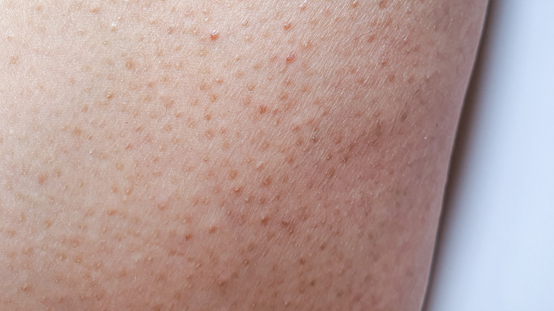 Skin with keratosis pilaris condition 