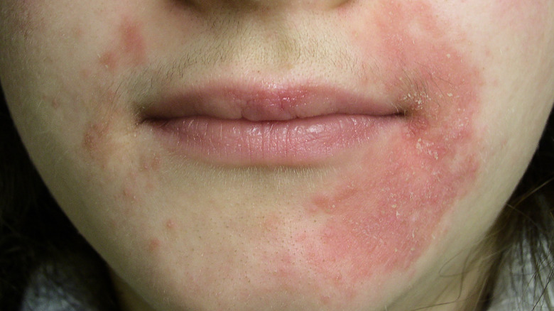 person with perioral dermatitis