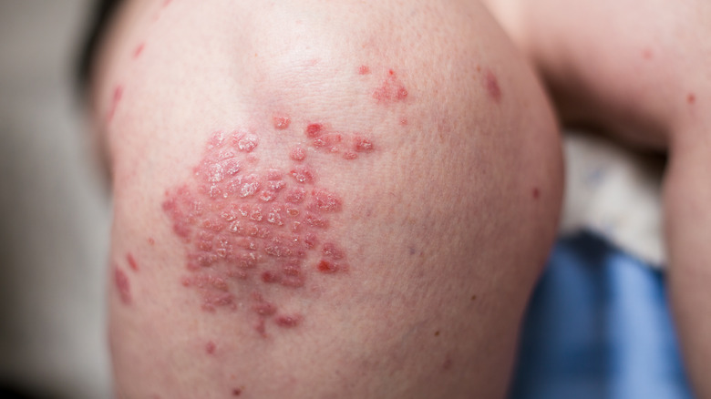 psoriasis on person's knee