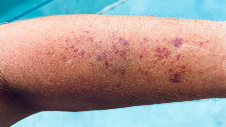 spots of senile purpura