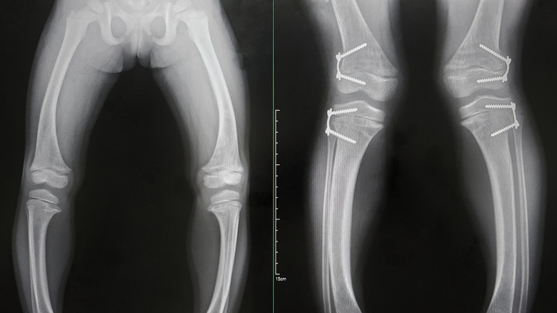 X-rays of a rickets patient's legs