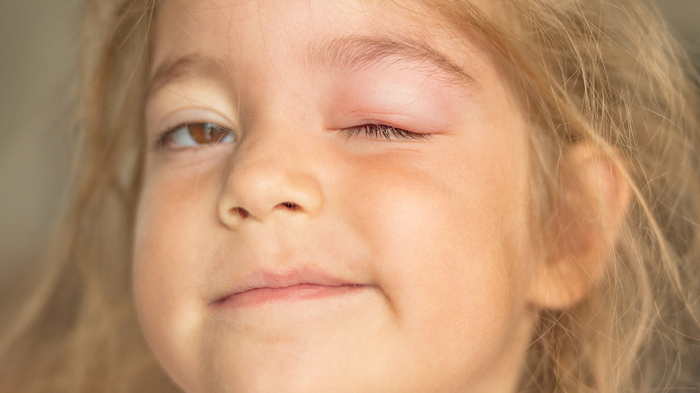 girl with mosquito bite reaction