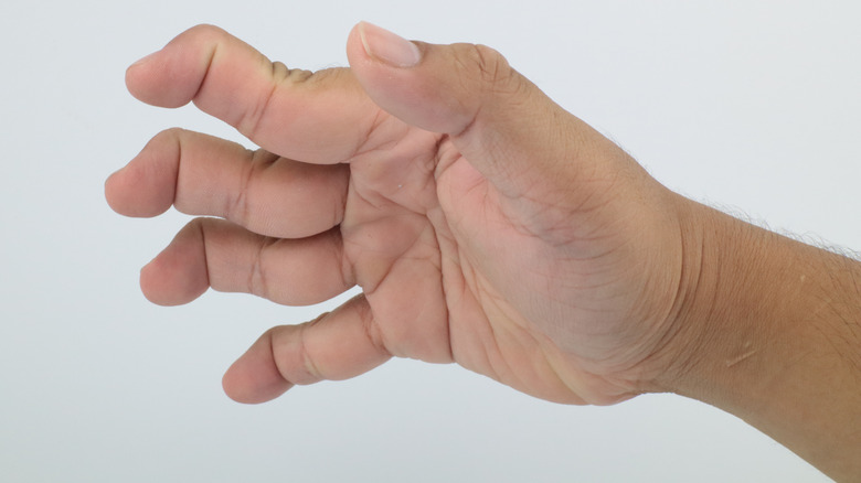 swan neck deformity in hand