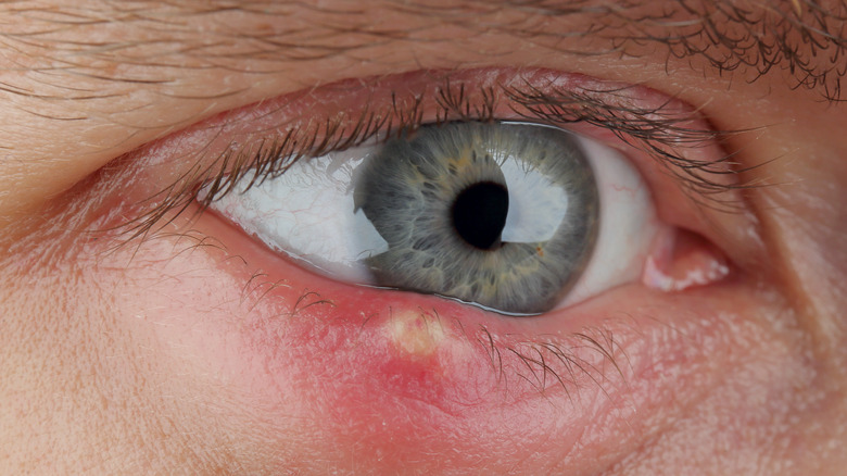 closeup of a stye