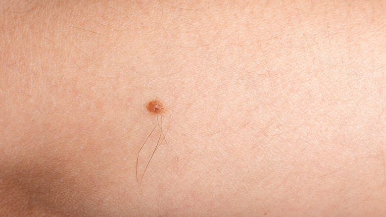 Hair growing out of mole