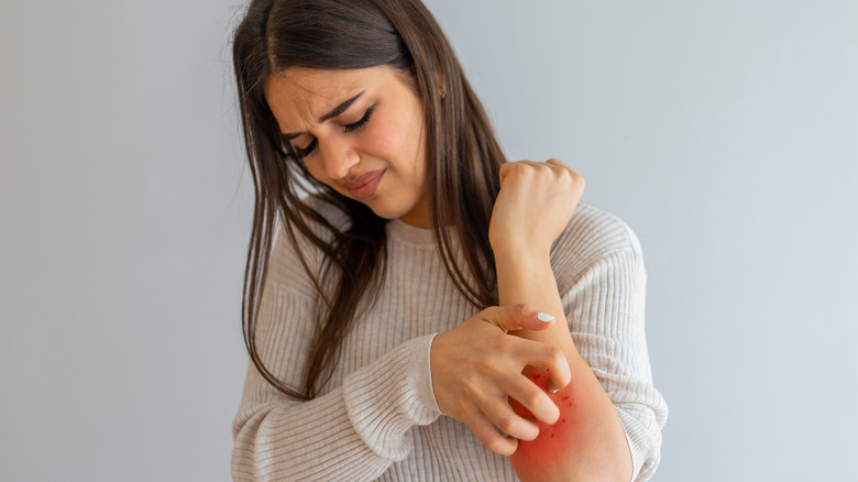 Woman with hives scratching her arm