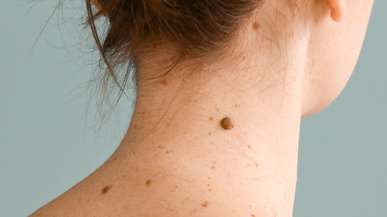 mole on woman's neck