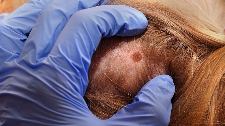 Hot topic Skinification of the scalp