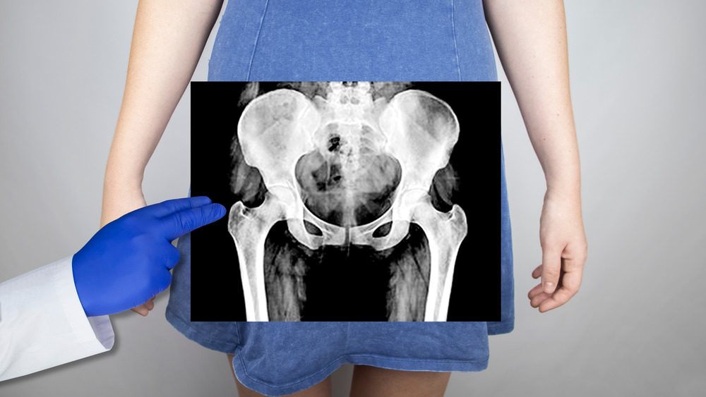 X-ray of a woman's pelvis 