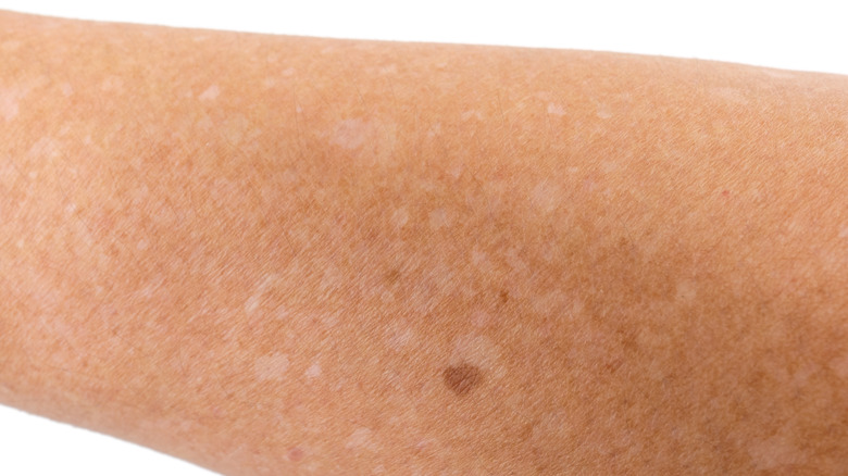 Man with white spots on skin