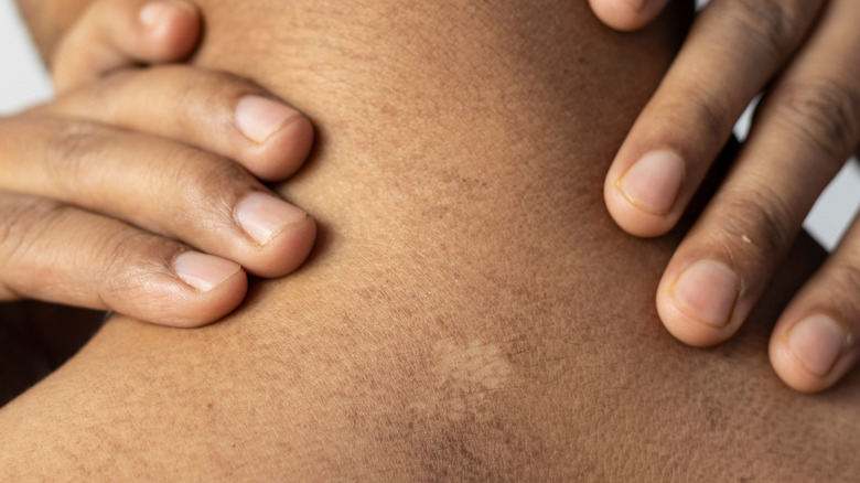 Man with white scar on back of neck