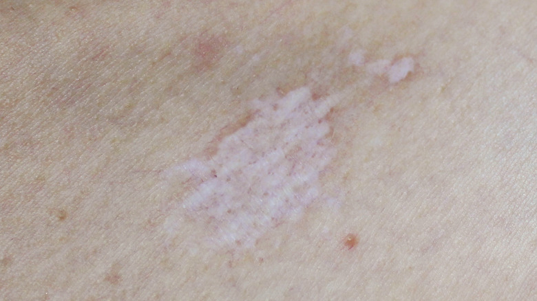 Spot of lichen sclerosus on skin