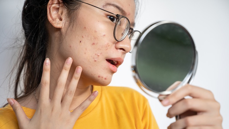 A woman looks at her acne