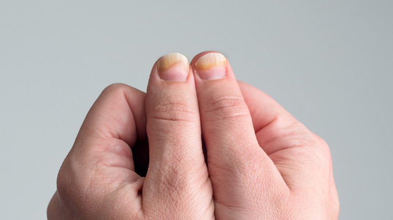 Close up of two thumbs with fungal nail infection