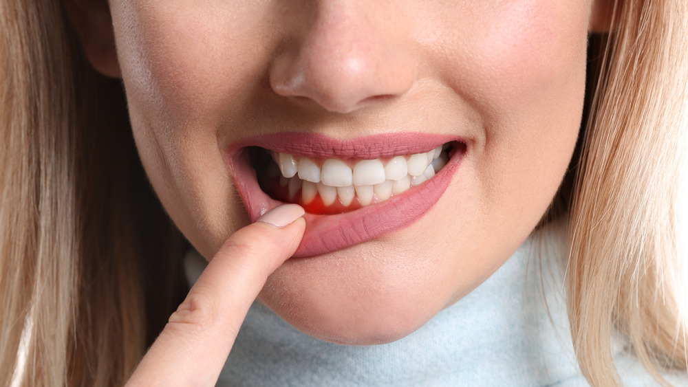 Woman with bleeding gums