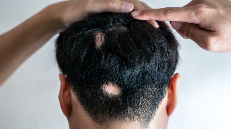 What It Really Means When Your Hair Loss Is Patchy