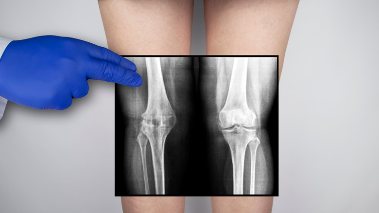 X-ray image of the knee joint