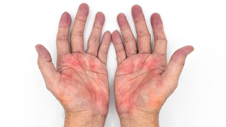 Hands with red palms and fingers