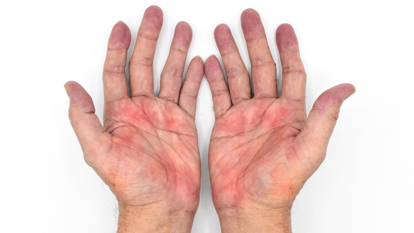 What It Really Means When Your Palms Turn Red