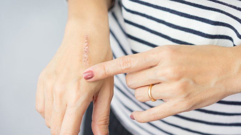 Woman pointing to scar on hand