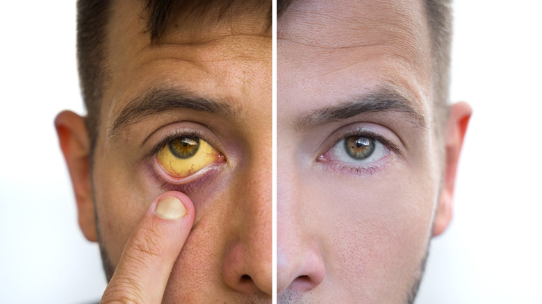 Close up of man with yellowing skin and yellowing eye