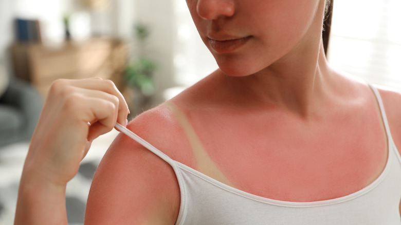 A woman has sunburned shoulders
