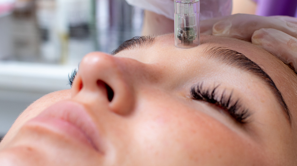 close-up of a microneedling treatment on a woman's face 
