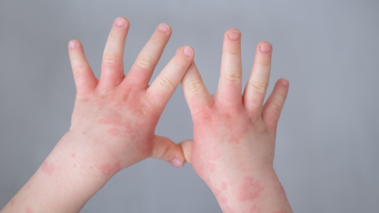Eczema on baby's hands