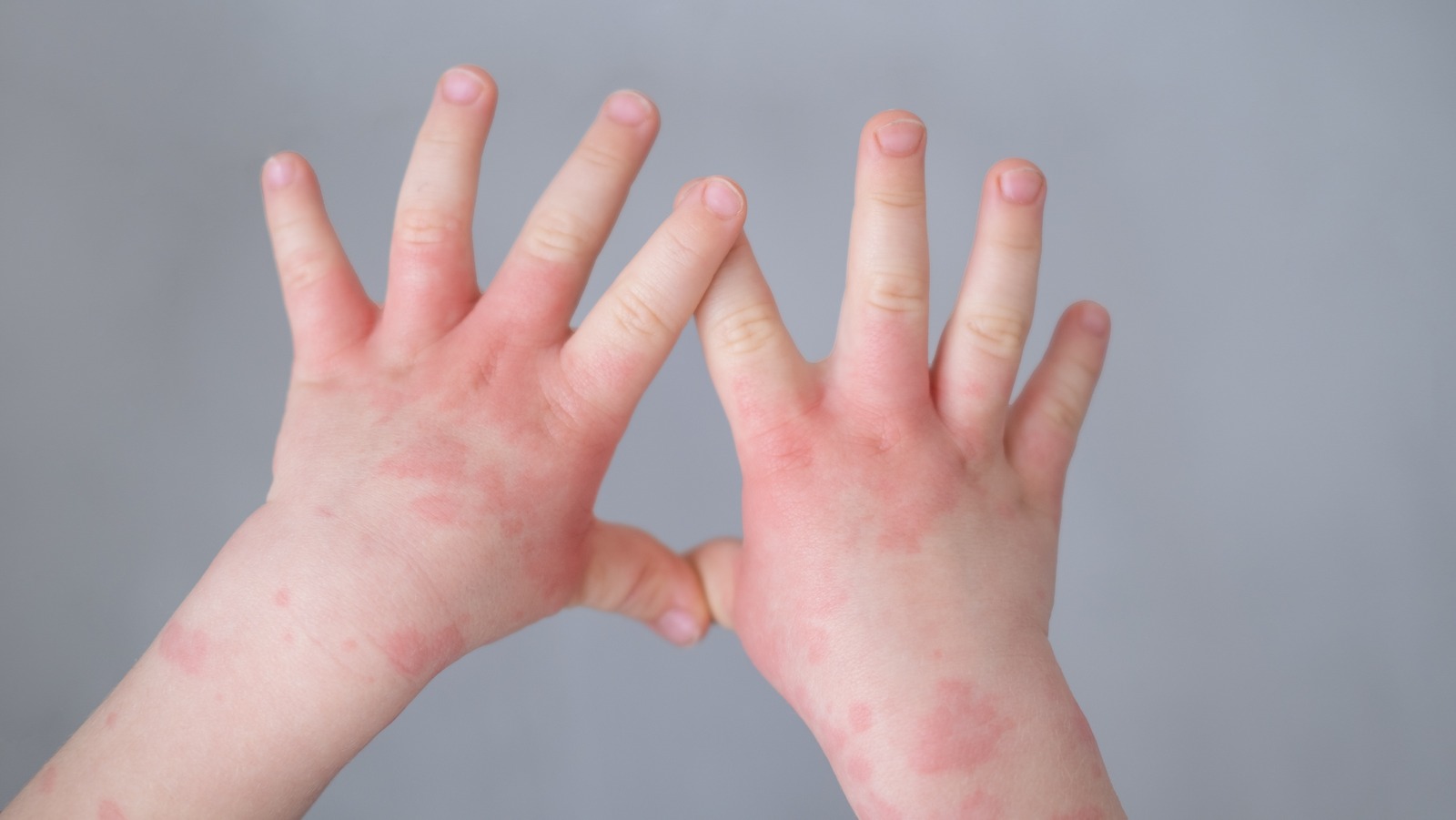 Psoriasis vs. Seborrheic Dermatitis: What's The Difference?