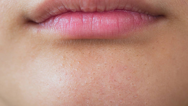 blackheads on chin